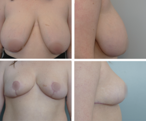 Breast Lift Portland Before and After by Dr. Tina Jenq
